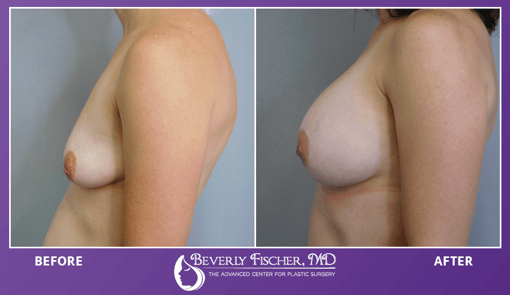 BF_MommyMakeover_Breasts_Side BeforeAfter_JS