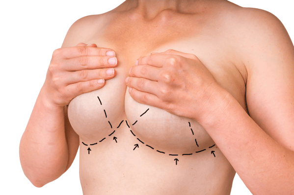 Can I Get a Breast Lift Without Implants Blog
