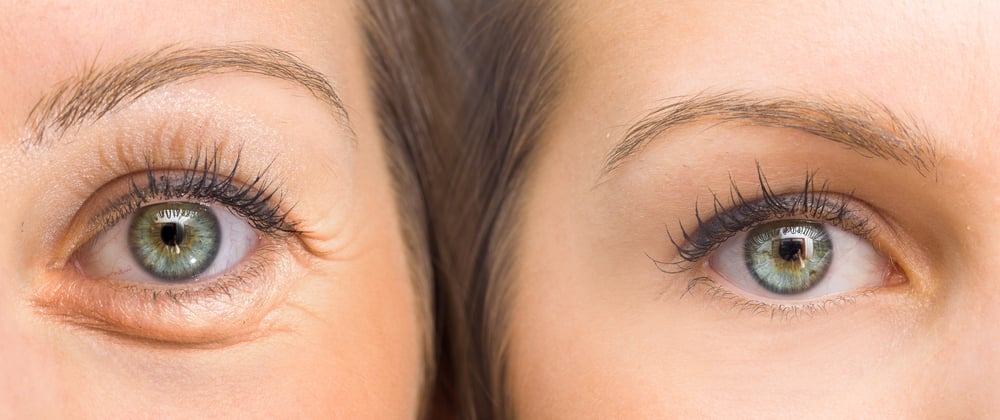 All About Eye Lifts: Upper, Lower, and Combo Bleph