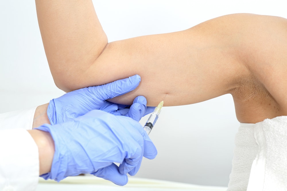 Arm Lift Overview: Say Goodbye to Bingo Wings