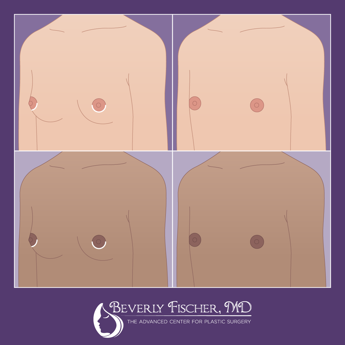 BF_FTM Surgery Graphics_1_1200px