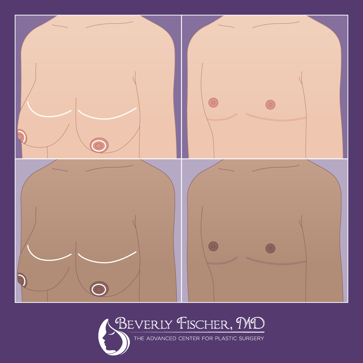 BF_FTM Surgery Graphics_2_1200px