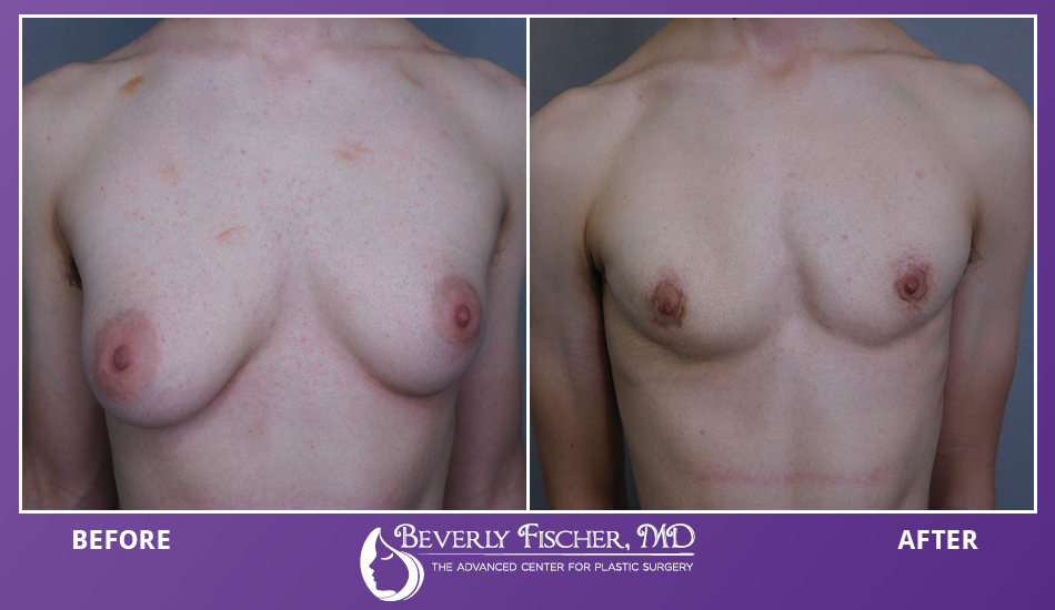Top Tips for Gender Affirming Top Surgery