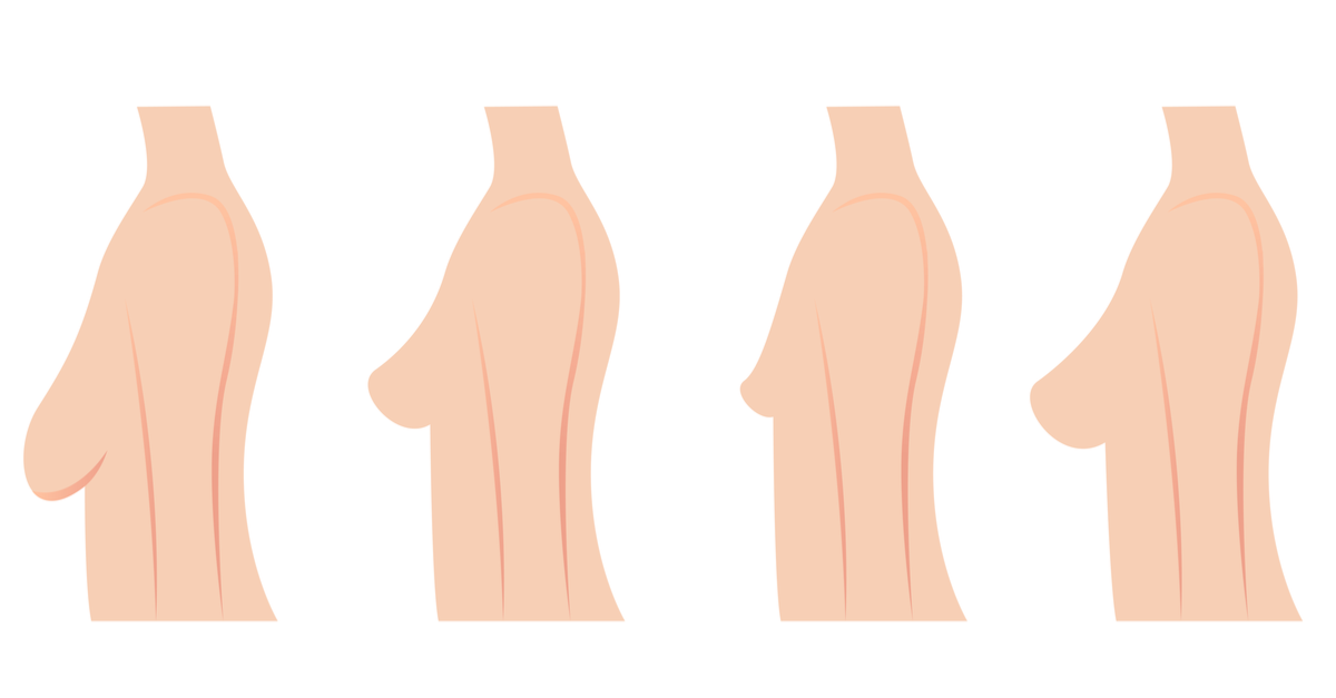Breast Lift & Reshaping | Dr. Beverly Fischer - The Advanced Center for Plastic Surgery