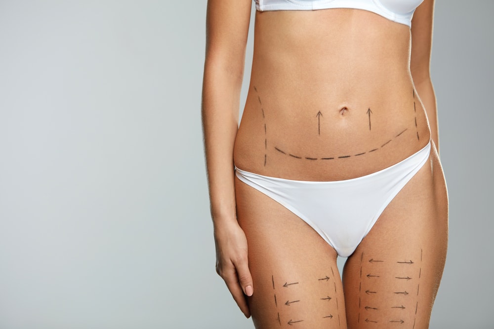 What is BodyTite? Is Scar-Free Body Lift Really a Thing?
