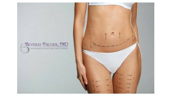 BodyTite scar-free body lift.png