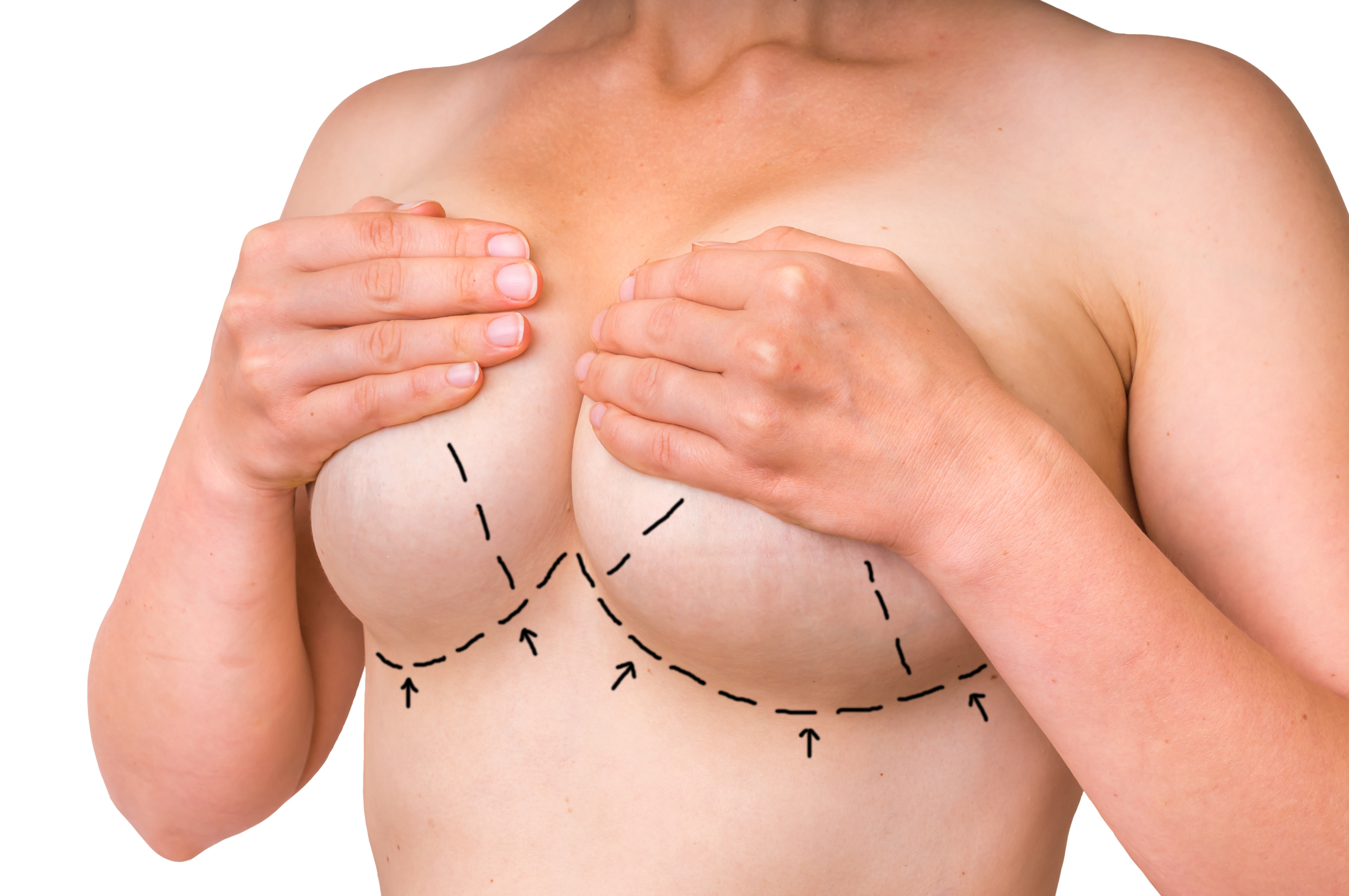 Can I Get a Breast Lift Without Implants?