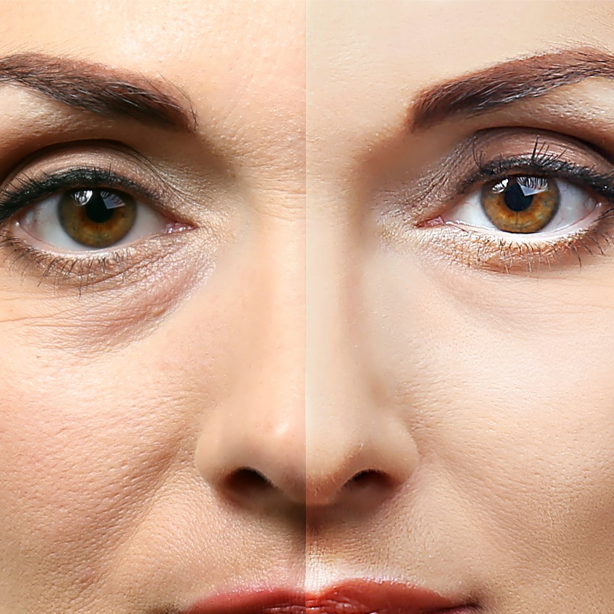 Keep Your Eyes Peeled: Eye Lift Safety and Recovery