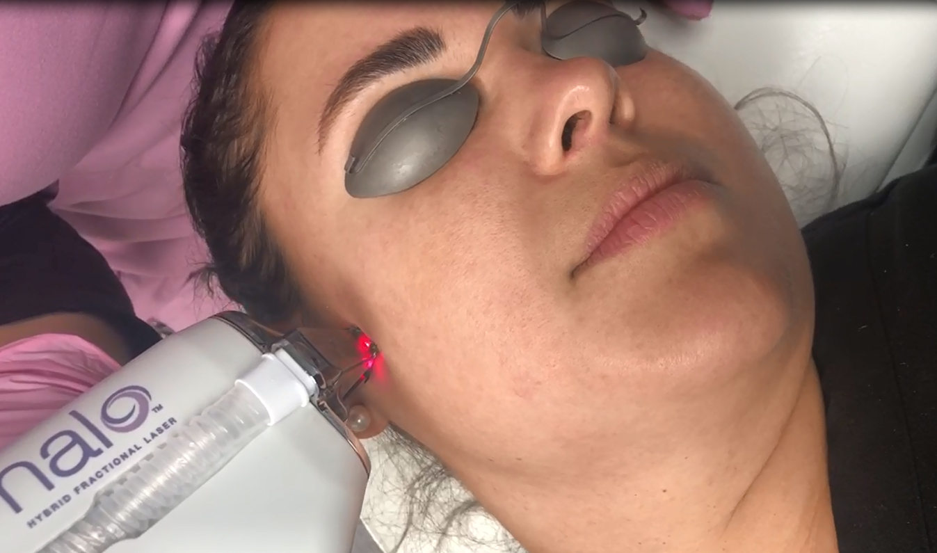 Halo Resurfacing: What To Expect Video Demonstration