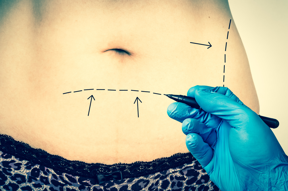 What You Need To Know About Abdominoplasty (Tummy Tucks)
