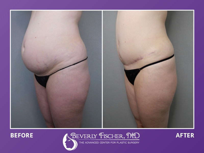tummy tuck before and after