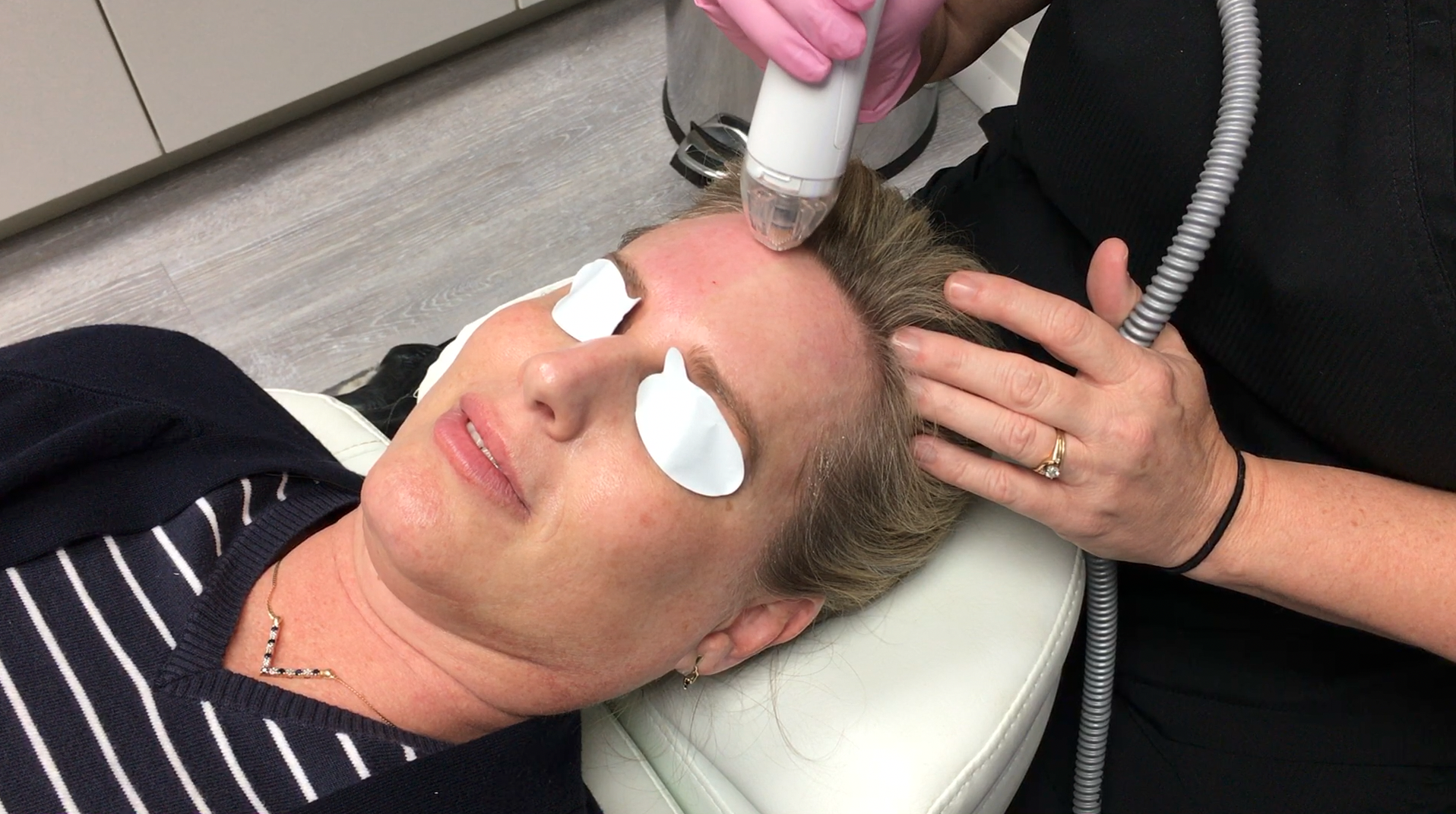 Vivace Microneedling: Everything You Need to Know