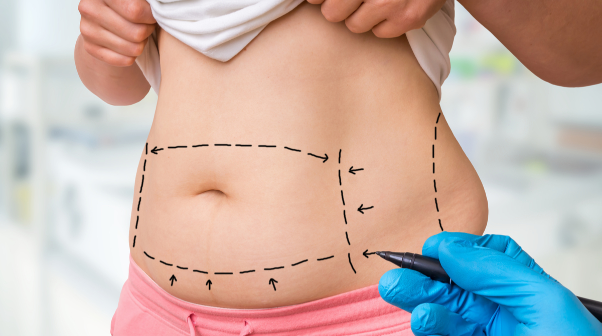 5 Questions You Should Be Asking About Liposuction