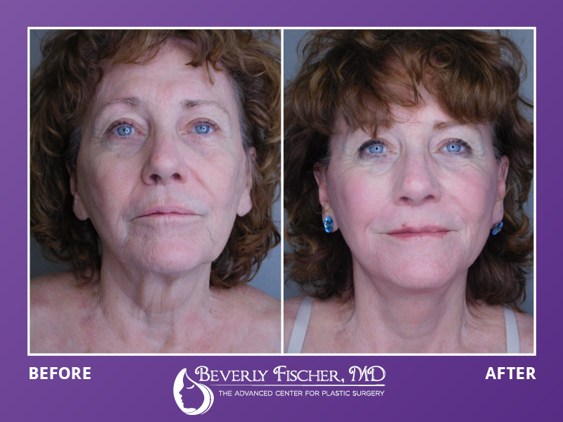 facelift before and after