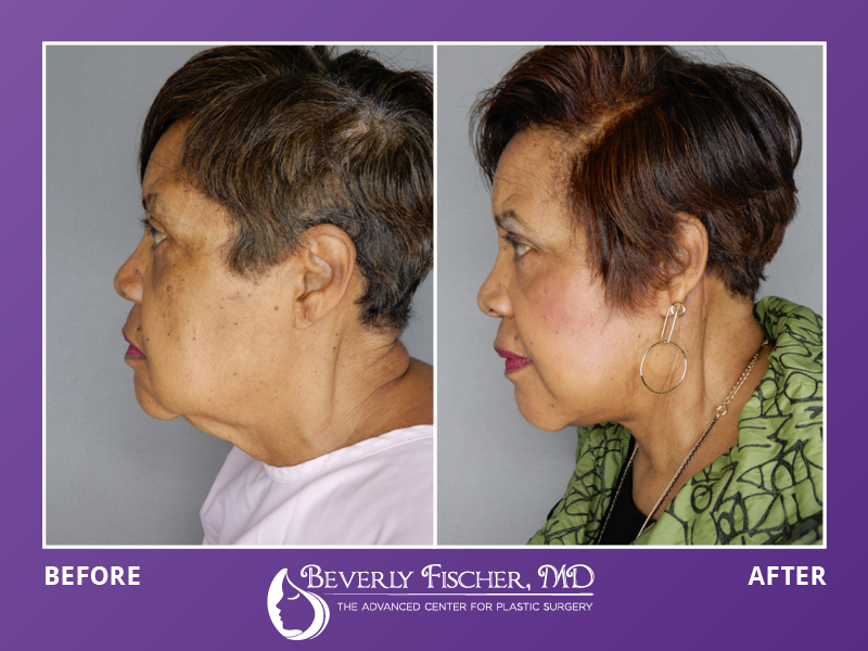 neck lift before and after
