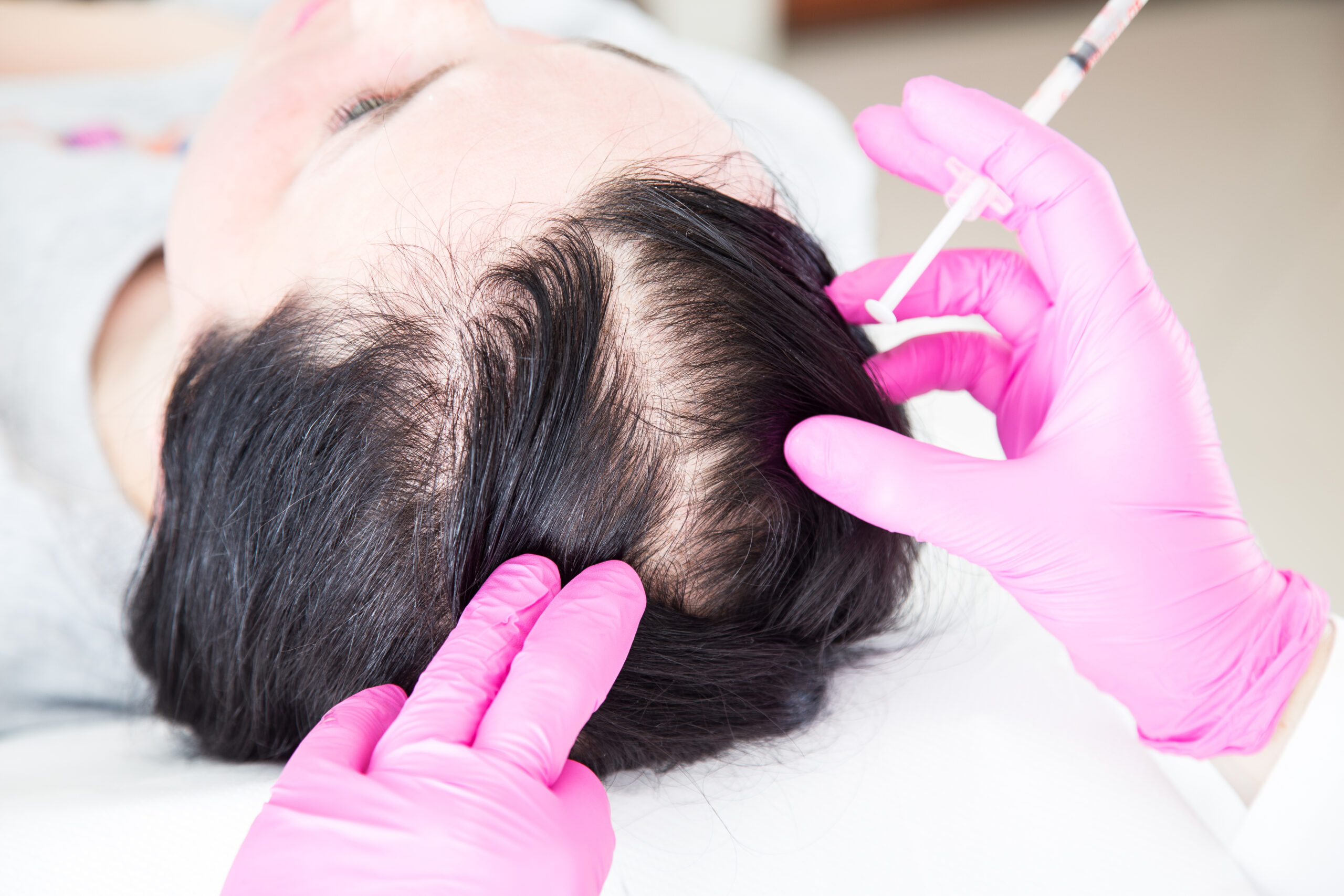 Thinning Hair: PRP Injections to the Scalp Can Help