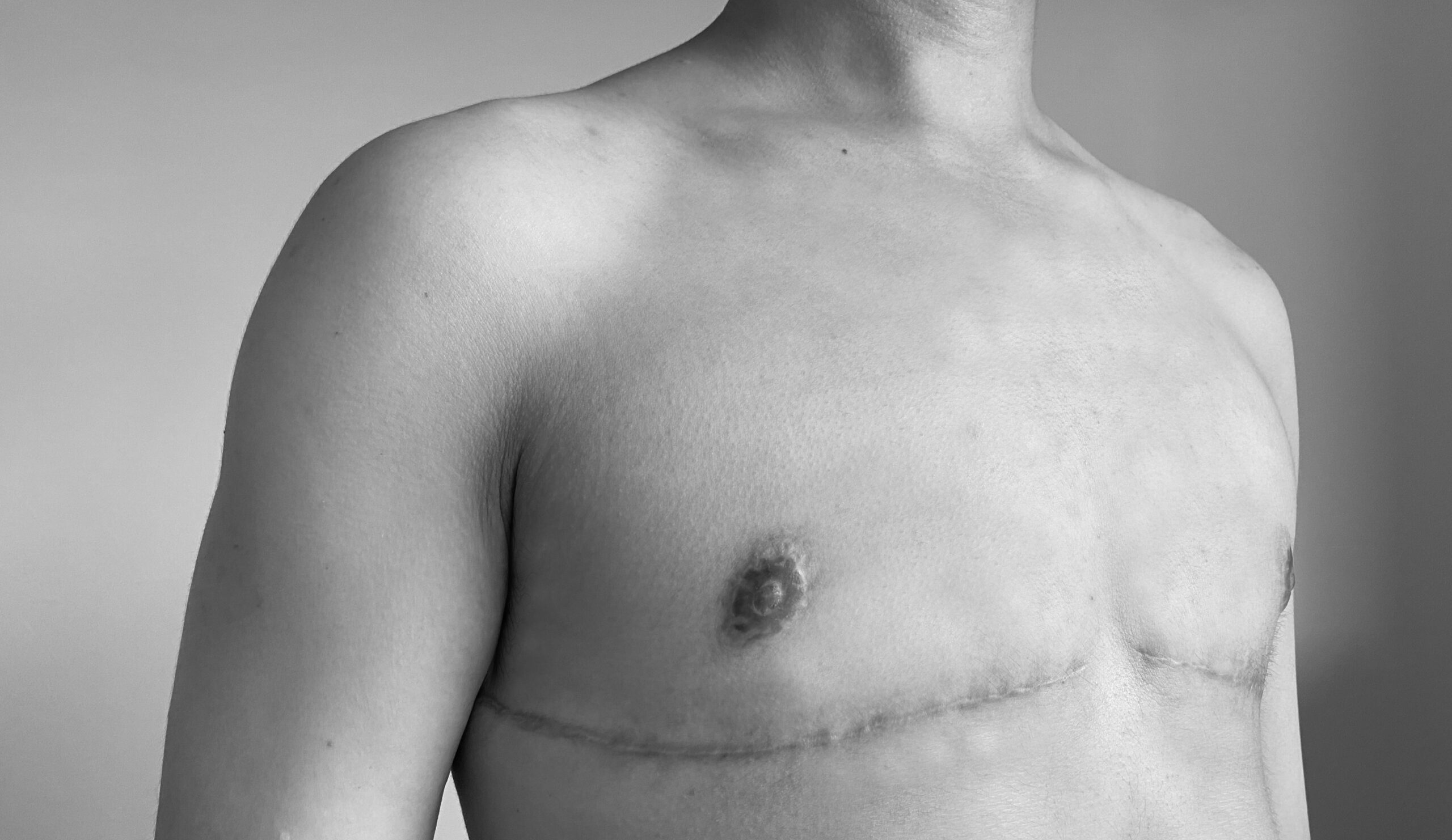 What is FTM Top Surgery Called?