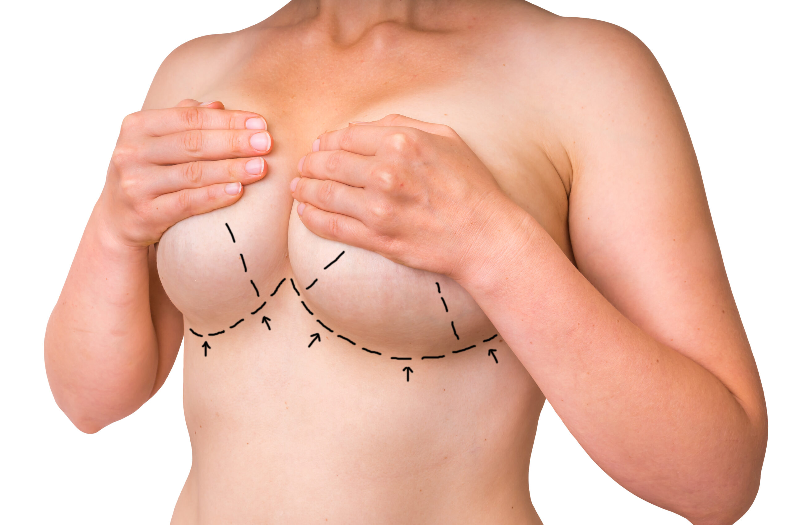 Breast Lift: What You Need to Know