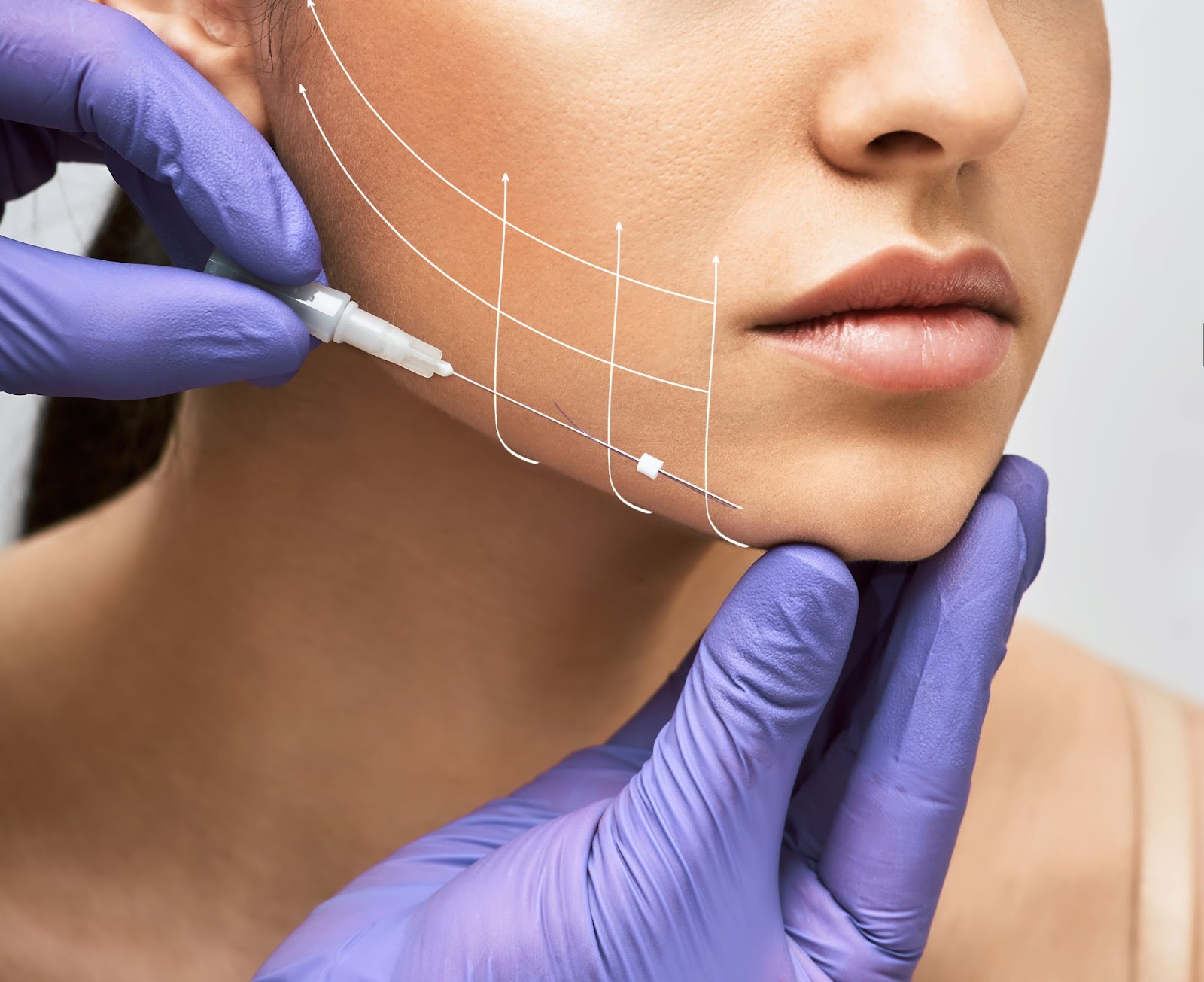 Thread Lift: An Anti-Aging Revolution