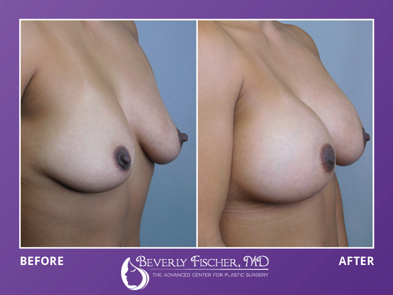 breast augmentation before and after