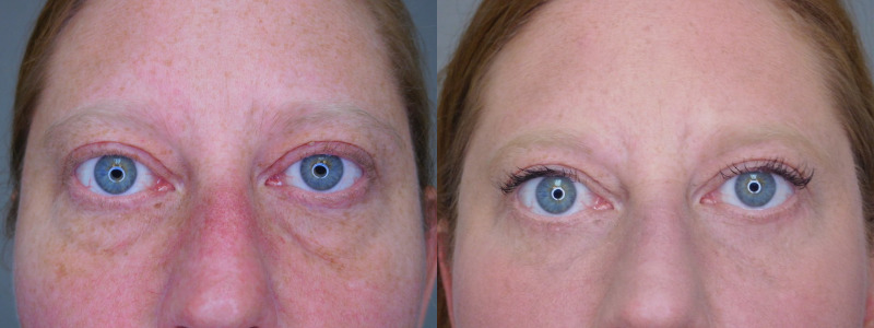 before and after blepharoplasty