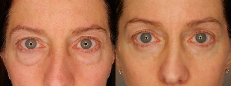 before and after blepharoplasty