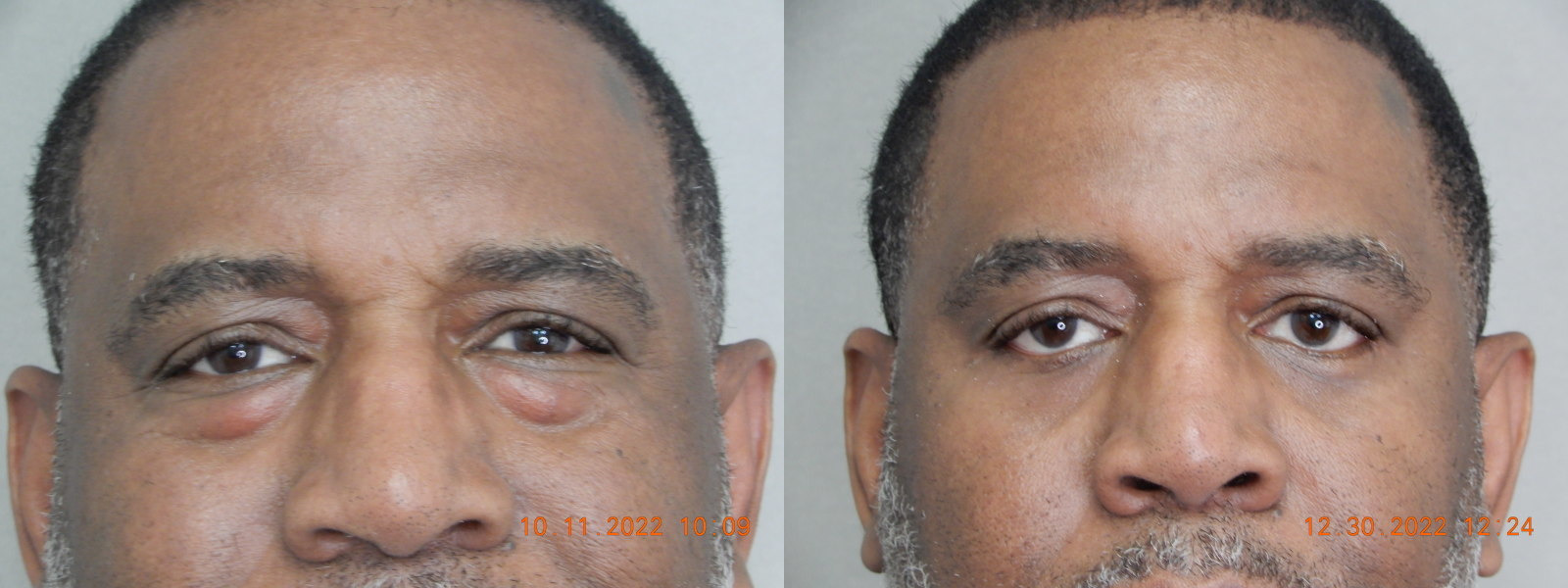 before and after blepharoplasty