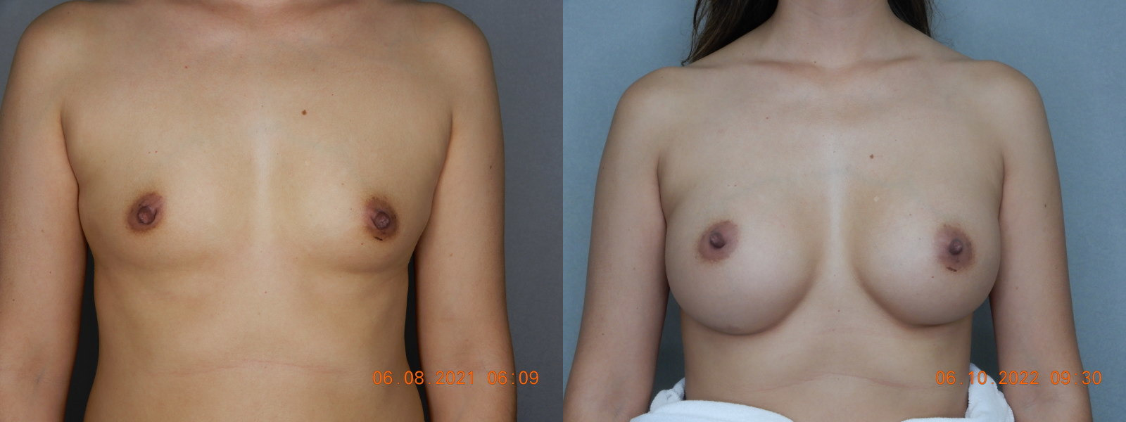 before and after breast augmentation