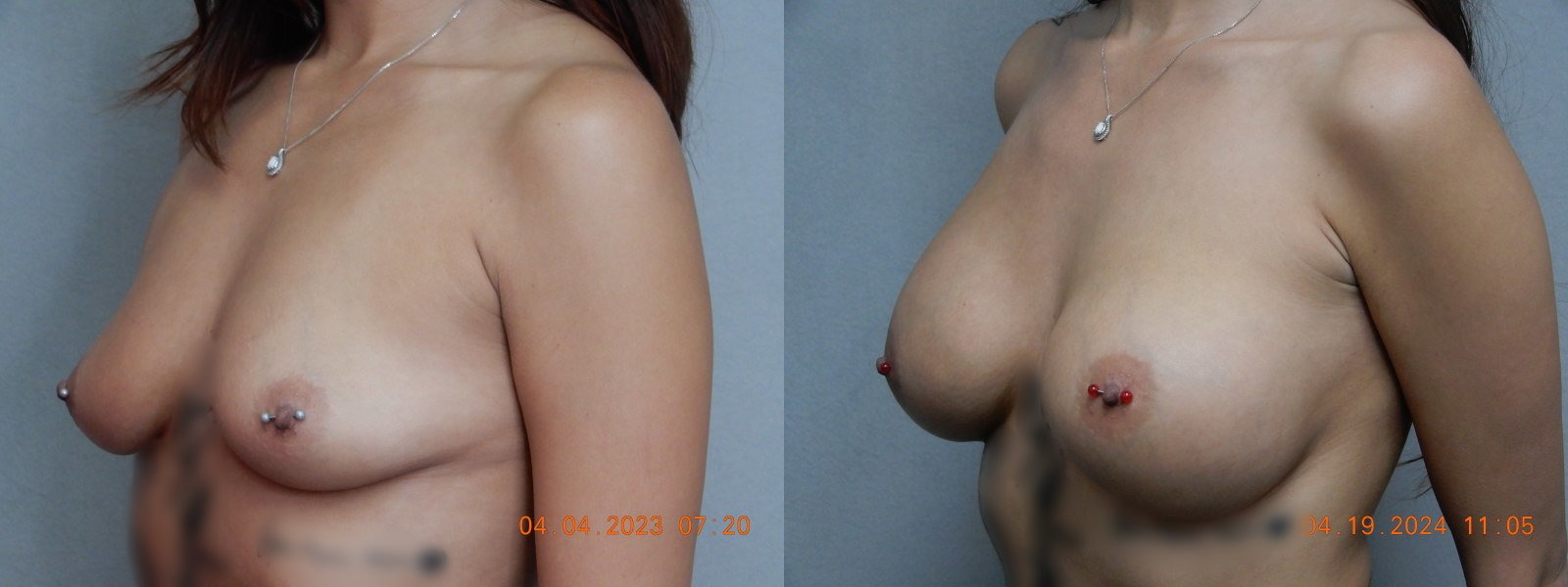 before and after breast augmentation