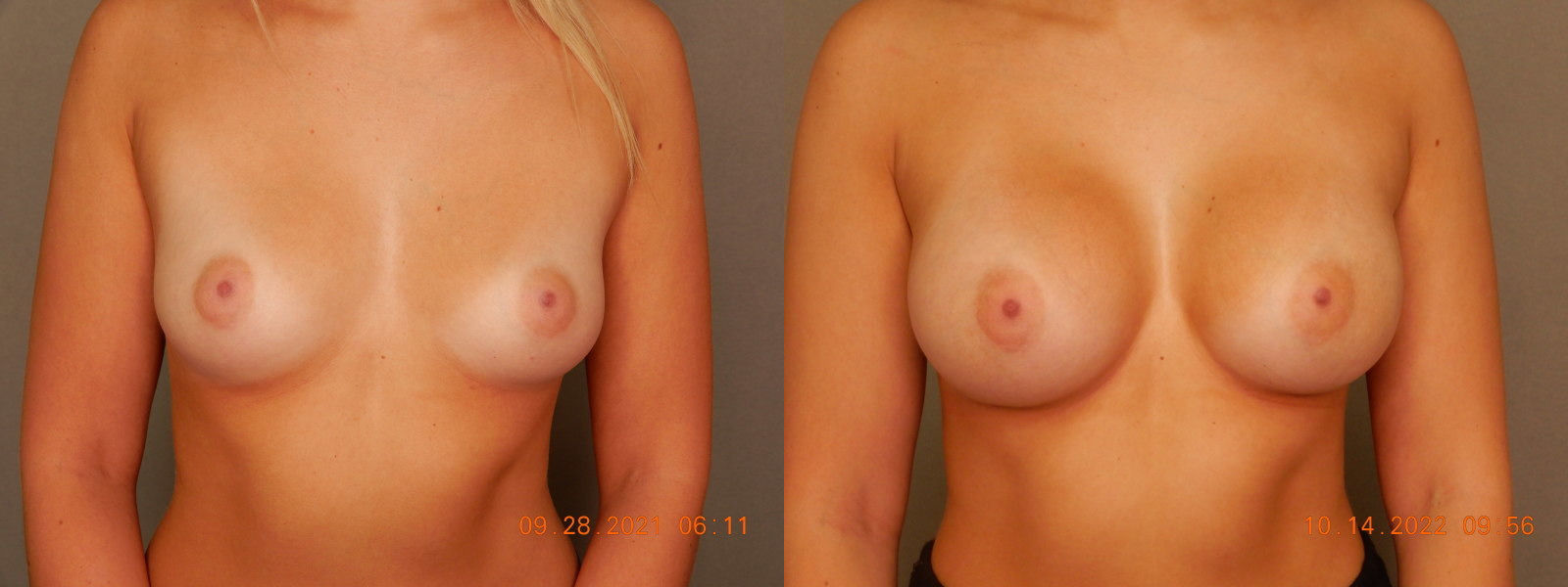 before and after breast augmentation