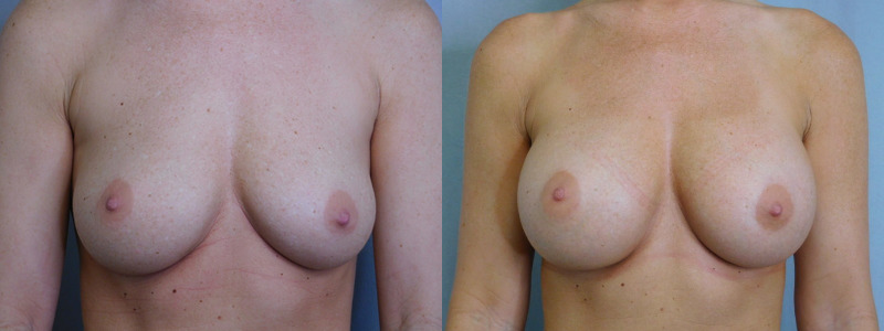 before and after breast augmentation