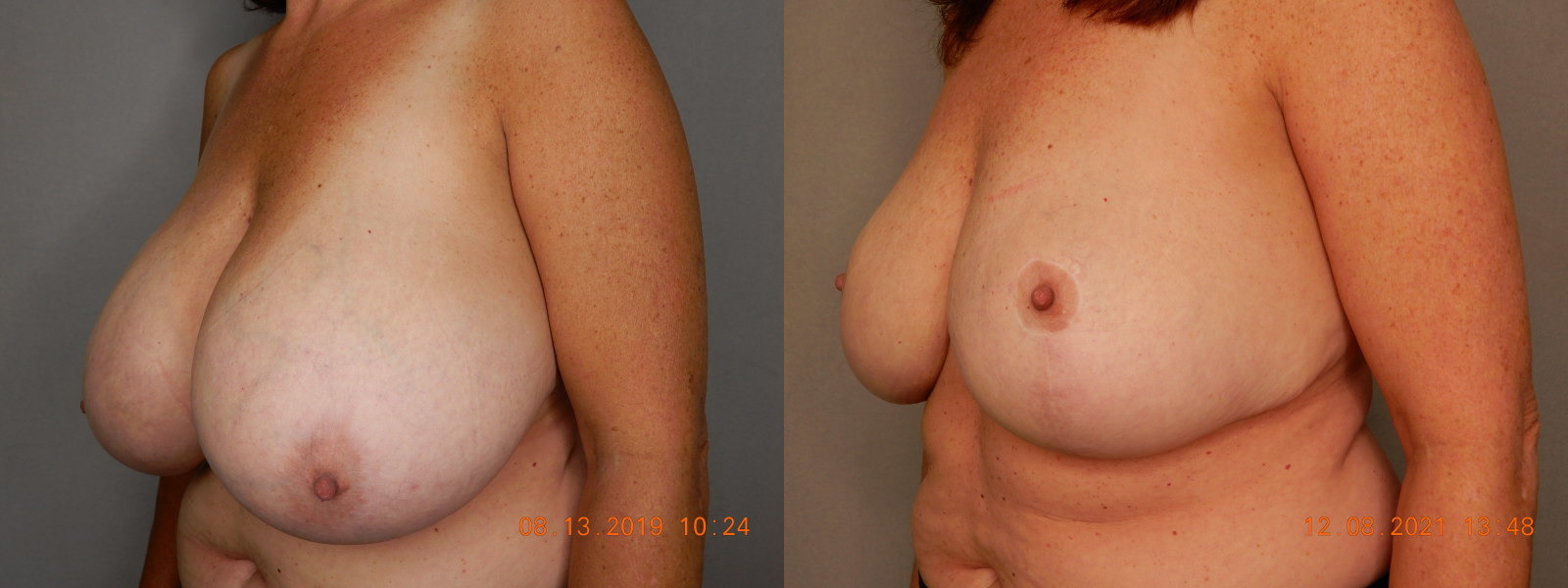 before and after breast reduction