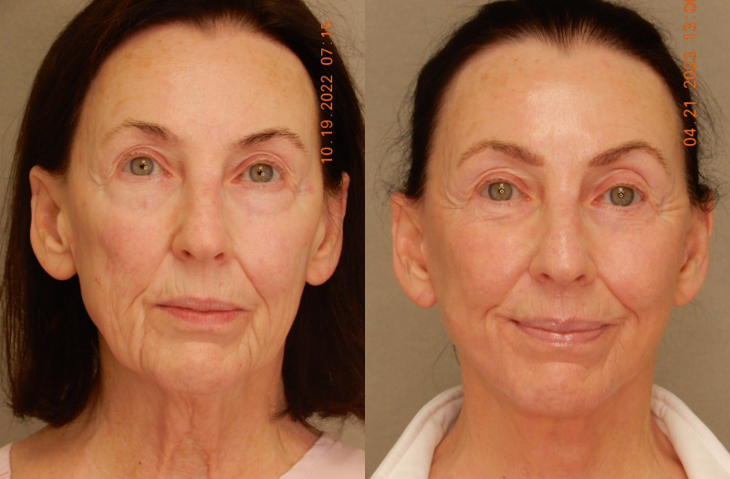 before and after facelift