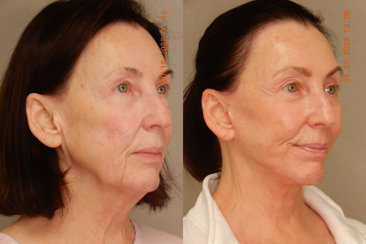 before and after facelift