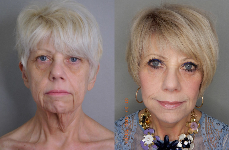 before and after facelift