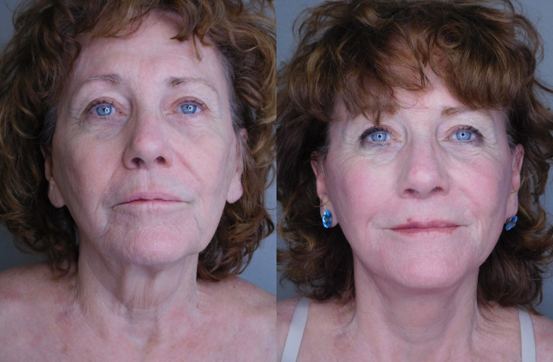 before and after facelift