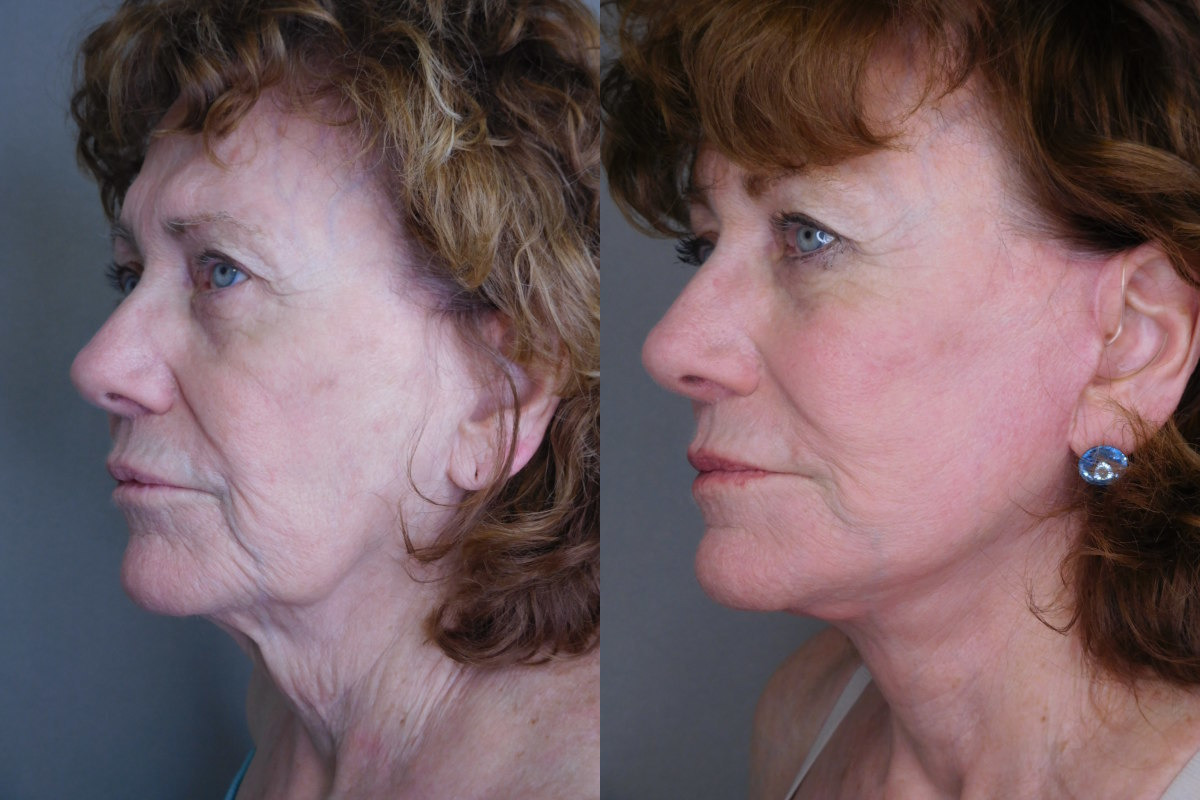 before and after facelift