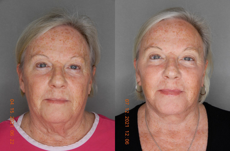 before and after facelift