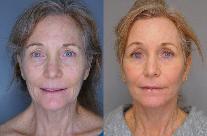 before and after facelift