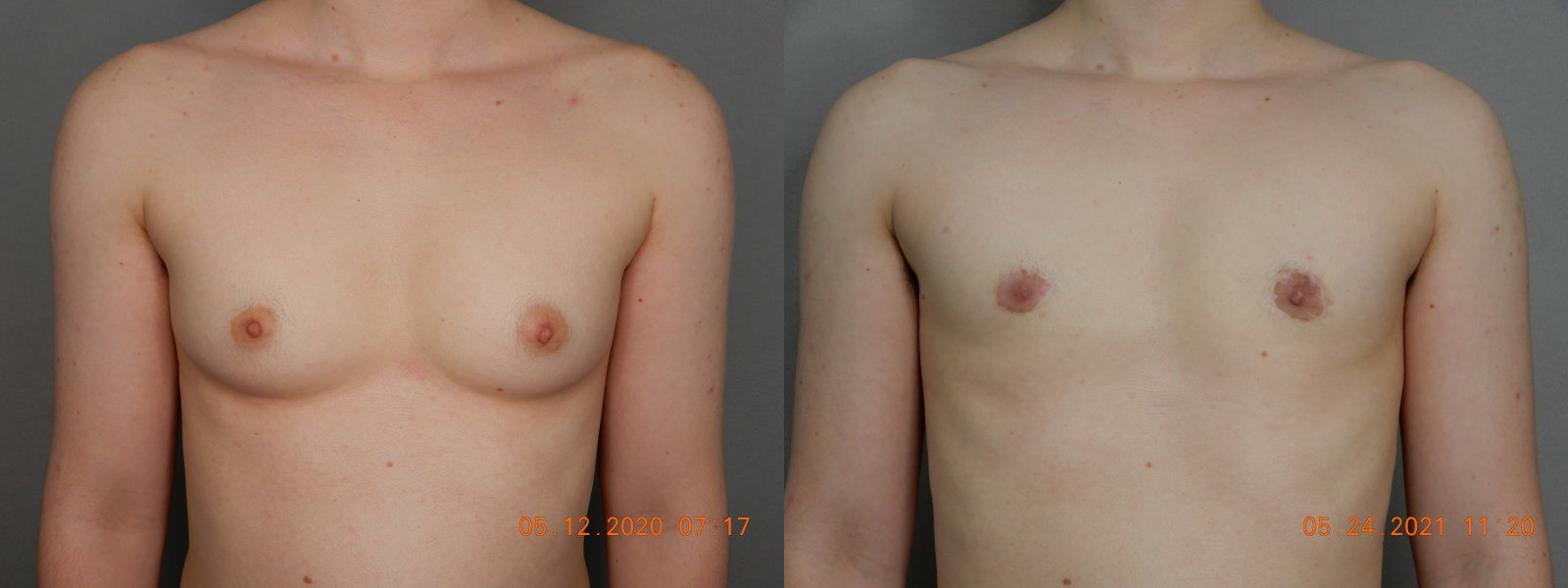 before and after female to male