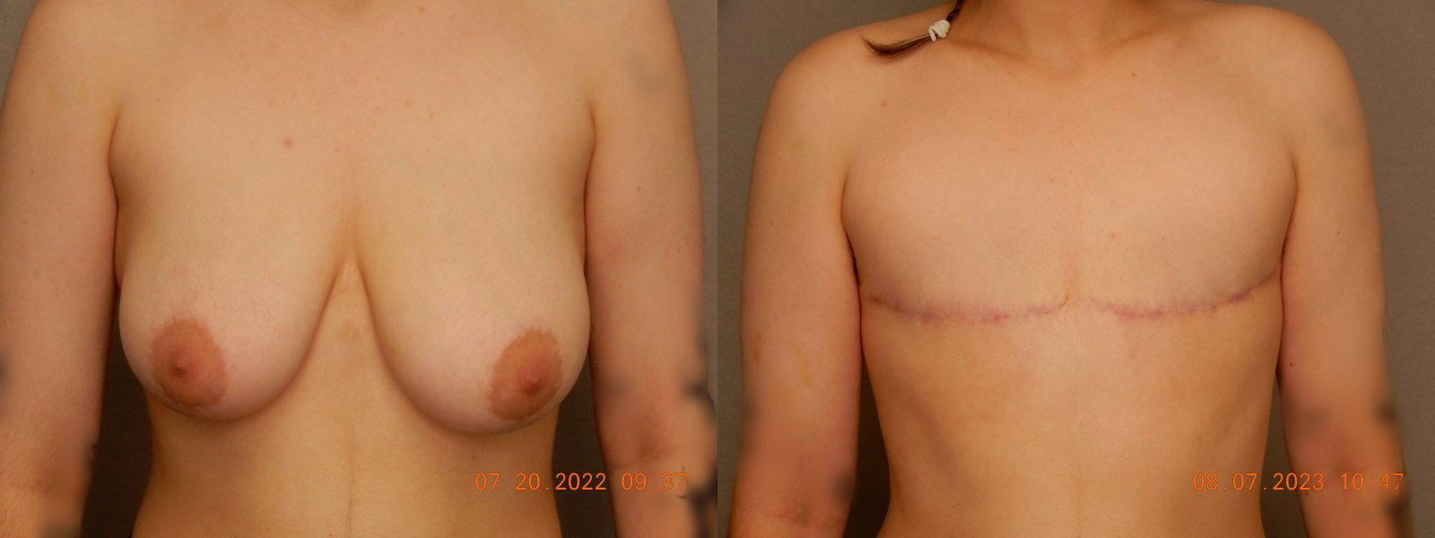 before and after female to male