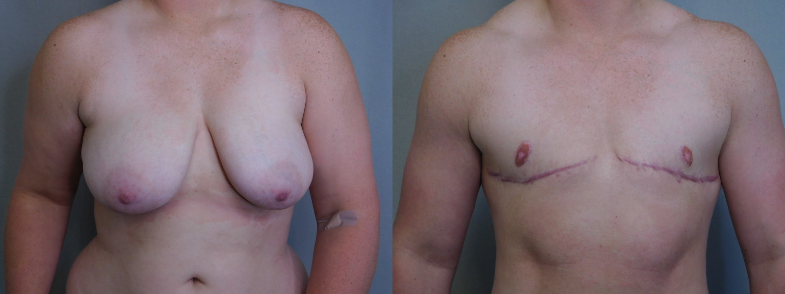 before and after female to male