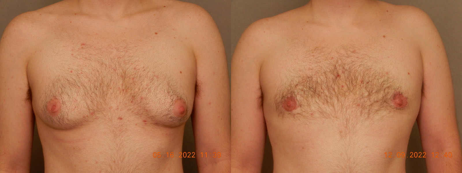 before and after female to male