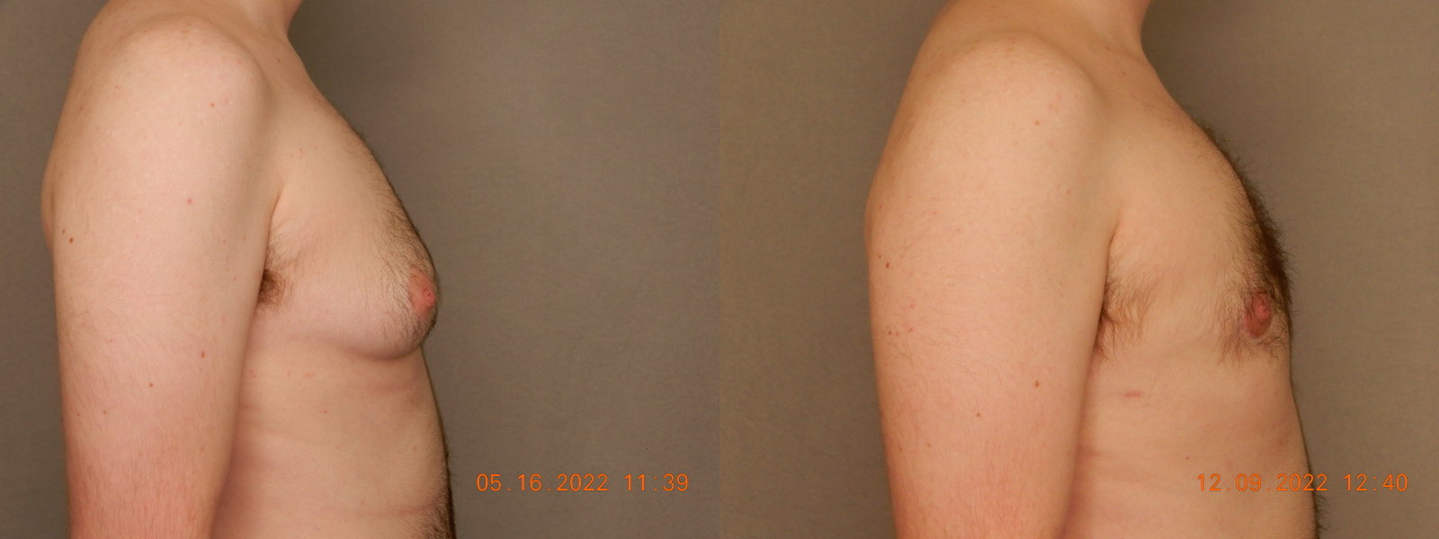 before and after female to male