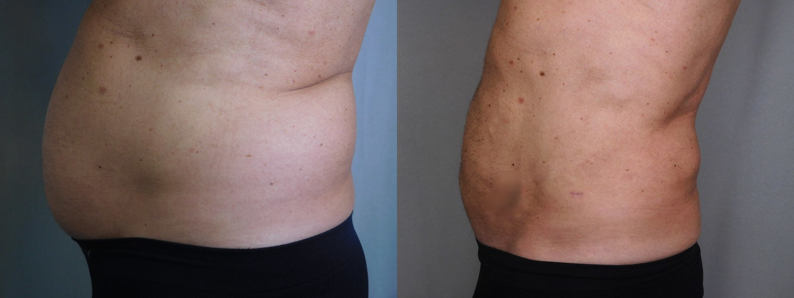 before and after liposuction