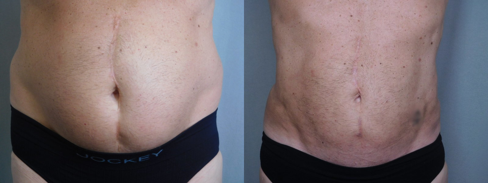 before and after liposuction
