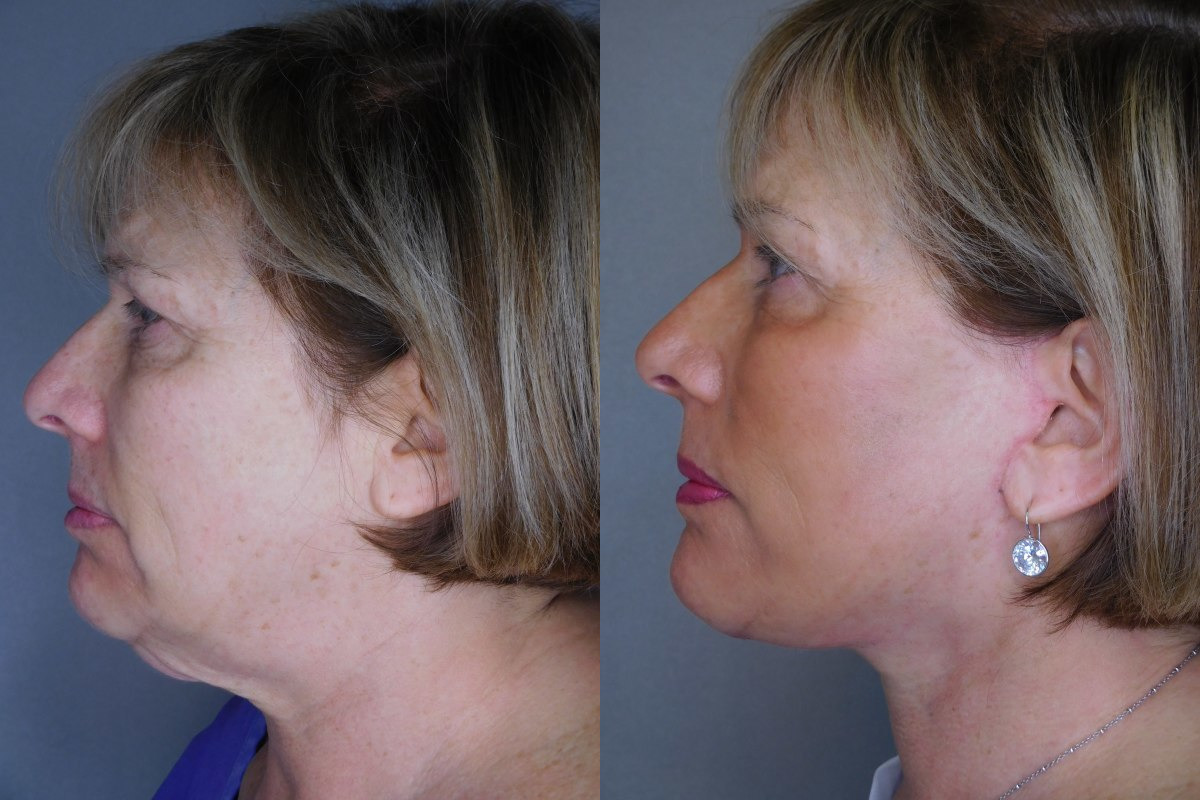 before and after neck lift