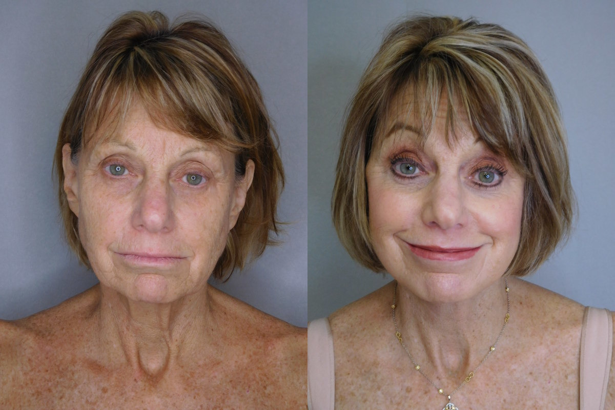 before and after neck lift