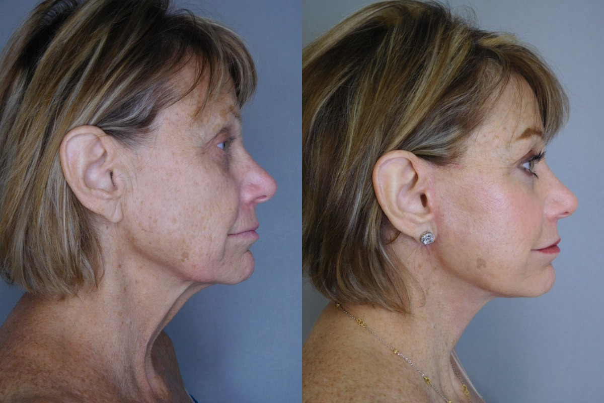 before and after neck lift
