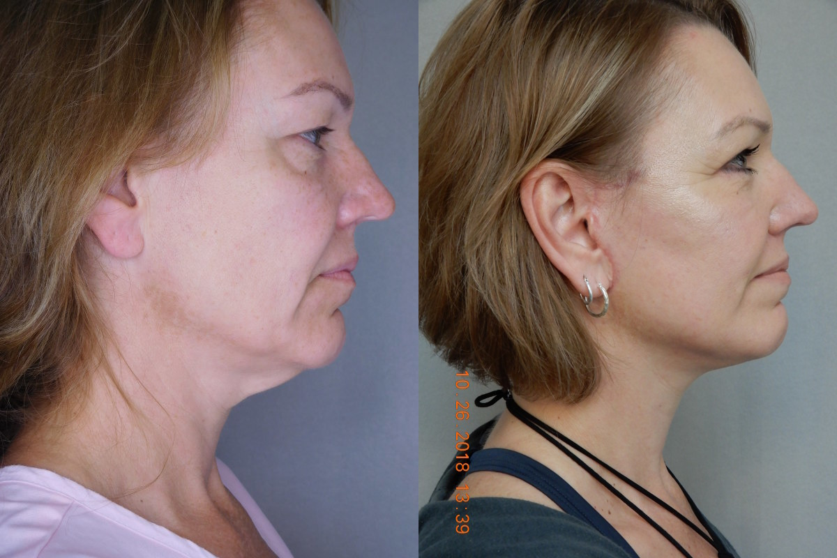 before and after neck lift